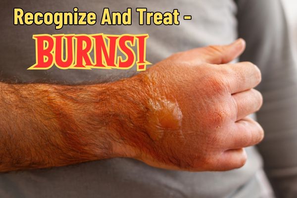 Burn Treatment: Recognition, Treatment, and Prevention 